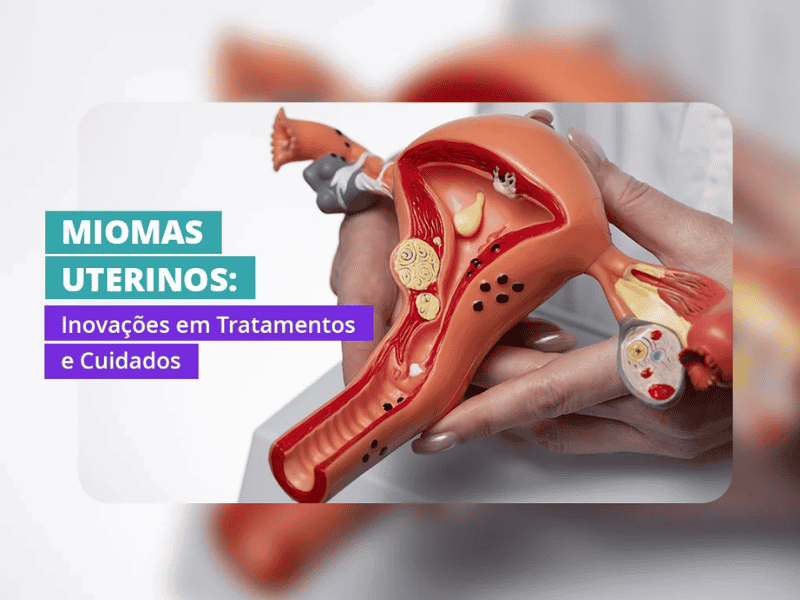 Miomas Uterinos: Causas, Tratamentos Avançados e Impacto na Saúde Feminina