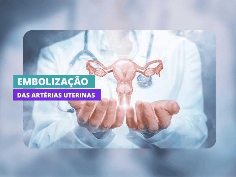 Como funciona a embolização das artérias uterinas?