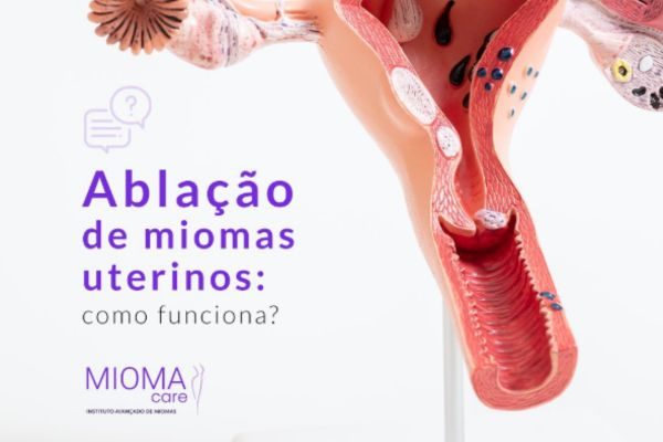 Ablação de Miomas Uterinos: Como Funciona?