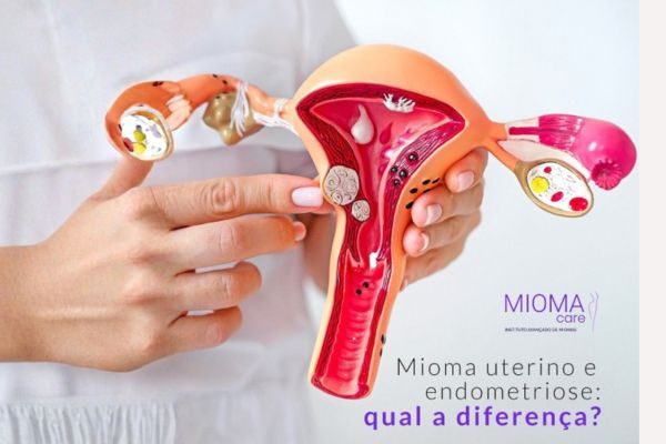 Mioma Uterino e Endometriose: Qual a Diferença?