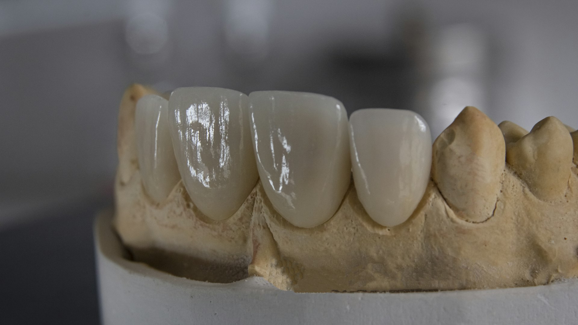 Prótese Protocolo: O Que É, Como Funciona e Por Que É a Solução Definitiva para Quem Perdeu os Dentes