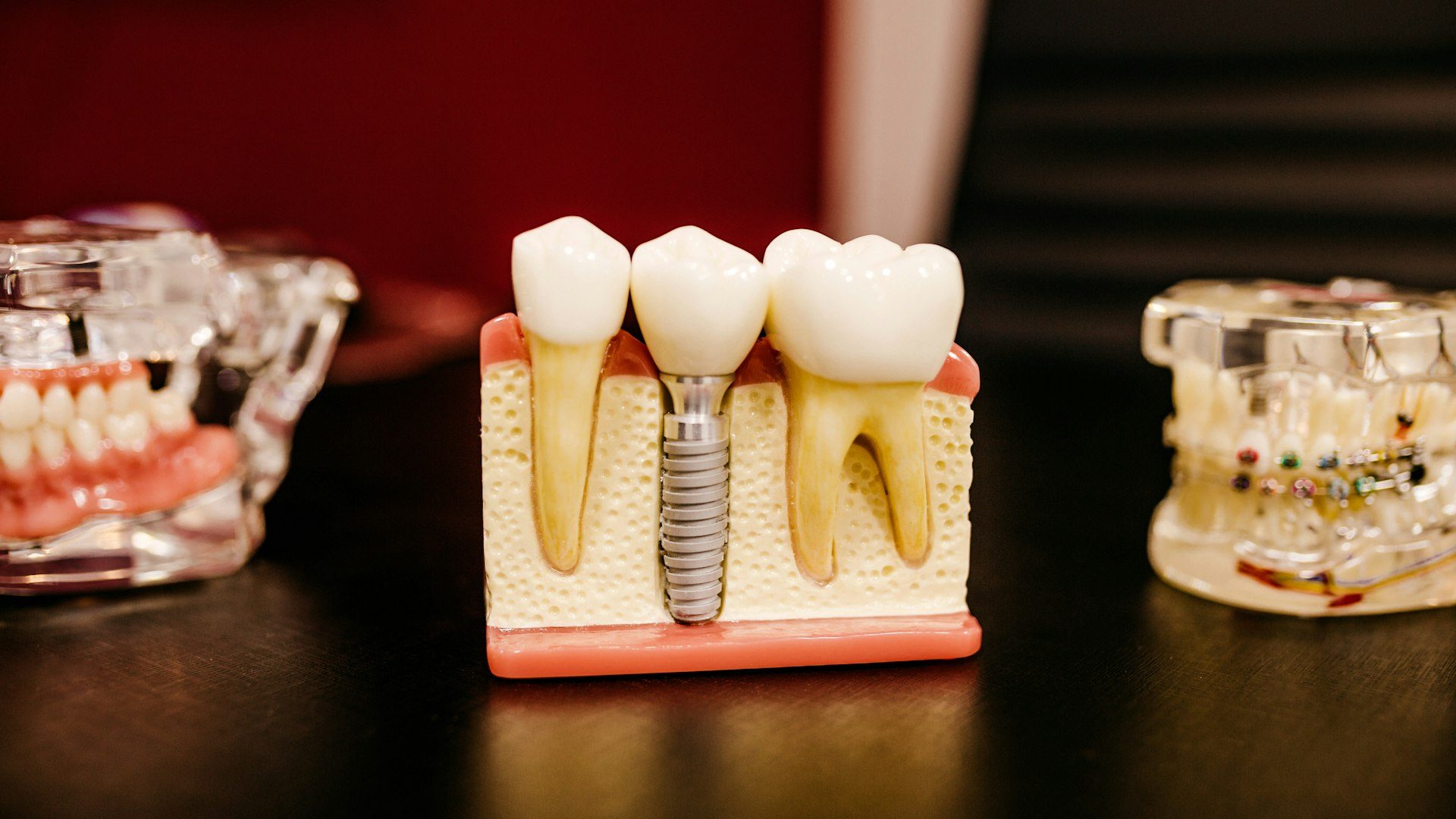 Quanto Tempo Dura um Implante Dentário? A Resposta Honesta de Quem Faz Há 22 Anos