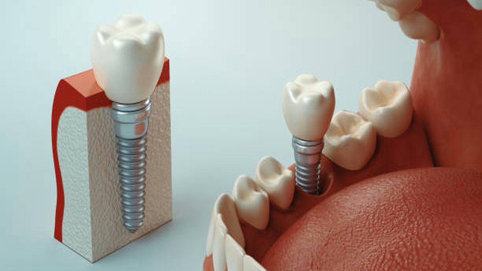 Implante de Titânio vs Zircônia: Qual a Diferença e Por Que Isso Importa para o seu Sorriso