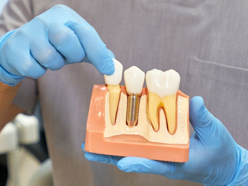 Implantes