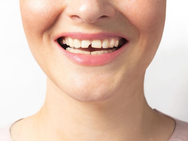 Tratamento para Dente Quebrado
