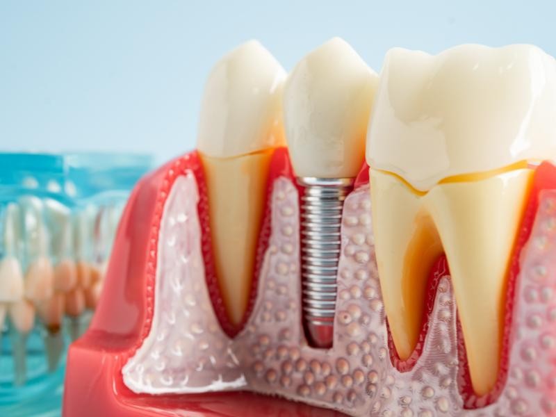 Prótese Dental Fixa