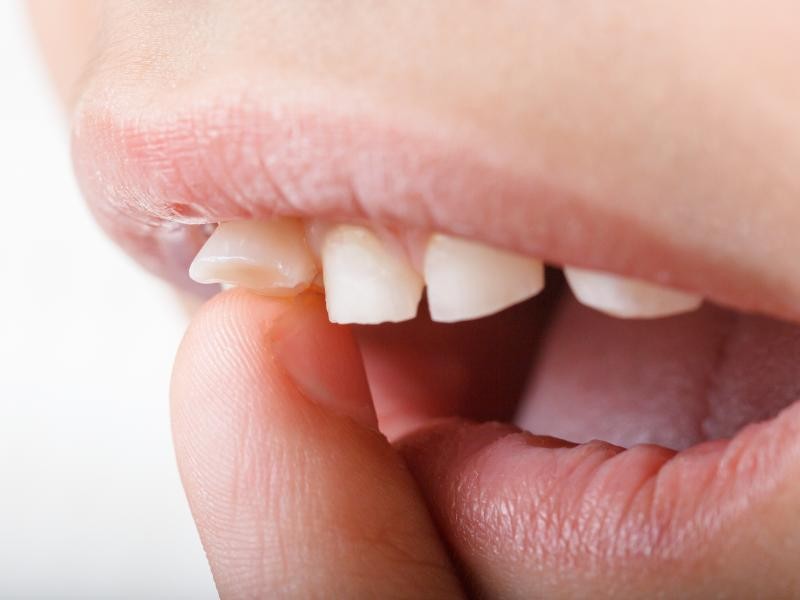 Tratamento para Desgaste dos Dentes