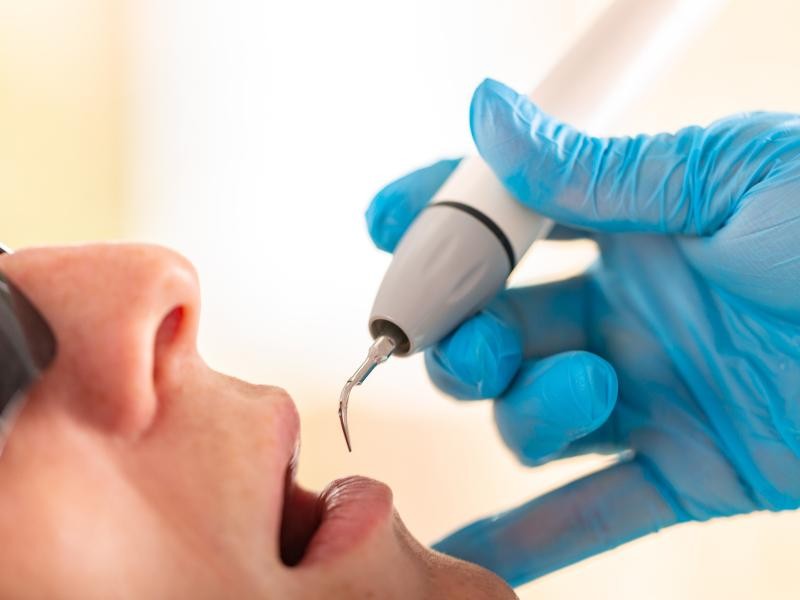 Remoção de Cálculo Dental