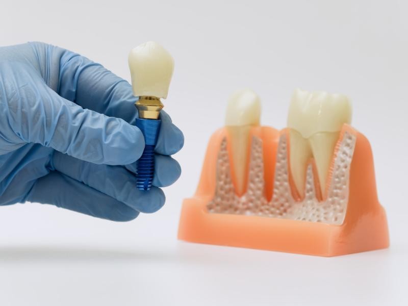 Reabilitação Oral com Implantes