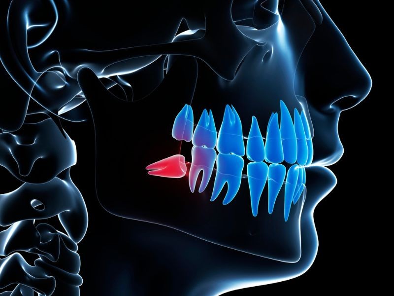 Exodontia de Dentes Inclusos/Dente do Siso