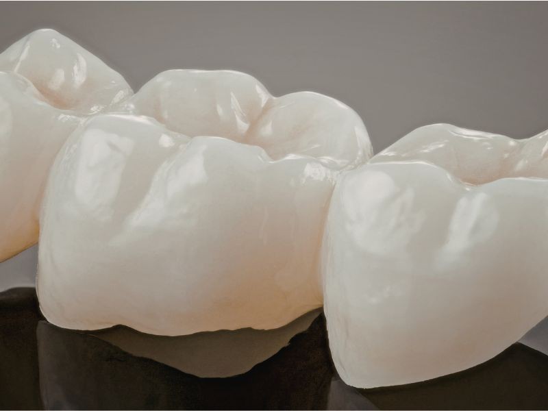 Coroas de Porcelana