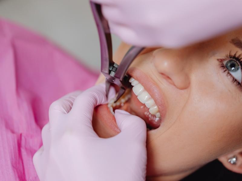 Extração Dental Complexa