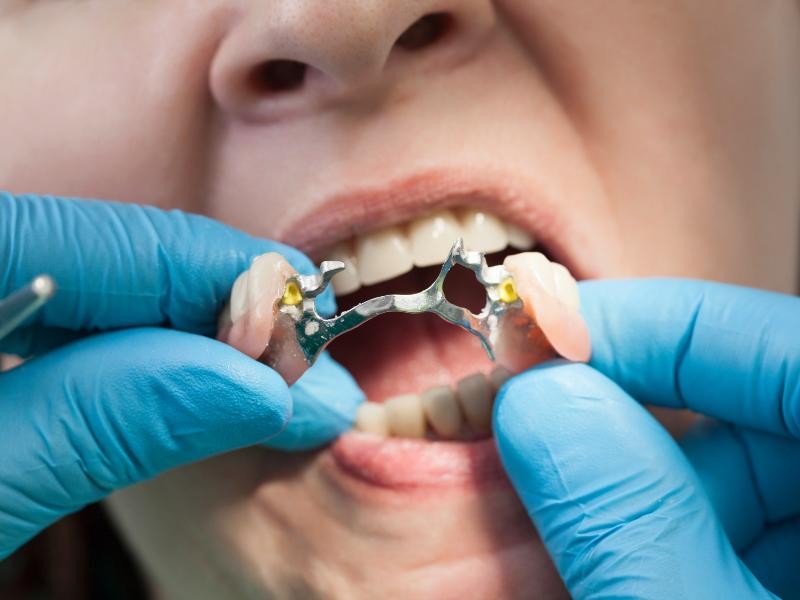 Prótese Dental Removível