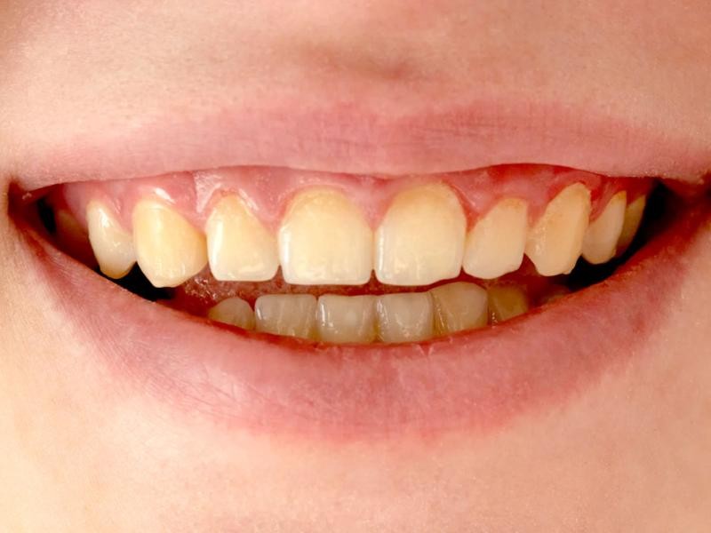 Tratamento para Alteração de Cor do Dente
