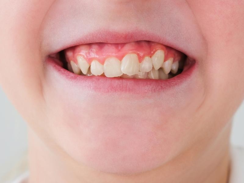 Tratamento para Dentes Tortos