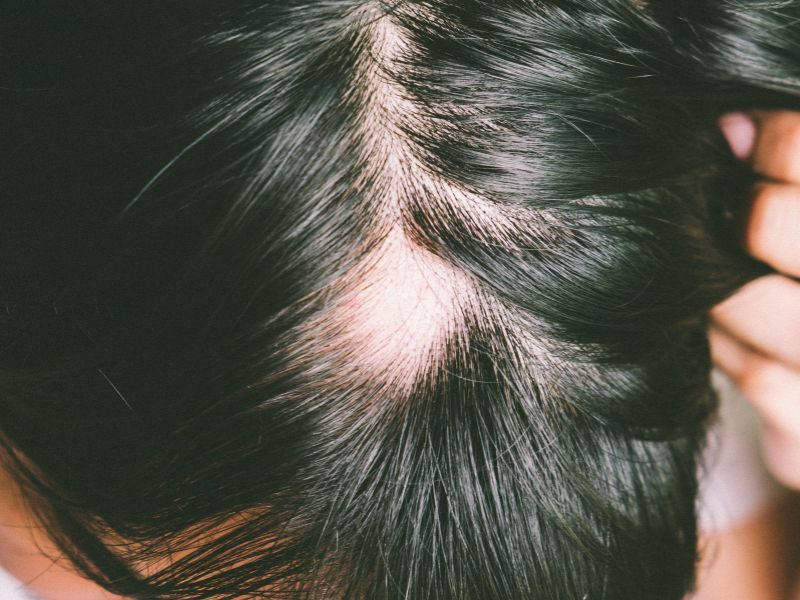 Tratamiento para la alopecia
