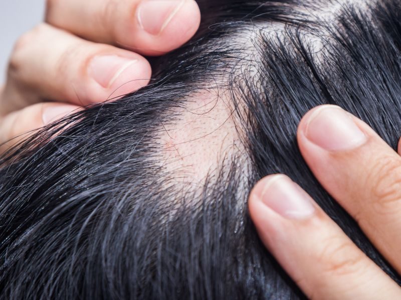 Tratamiento para la alopecia areata
