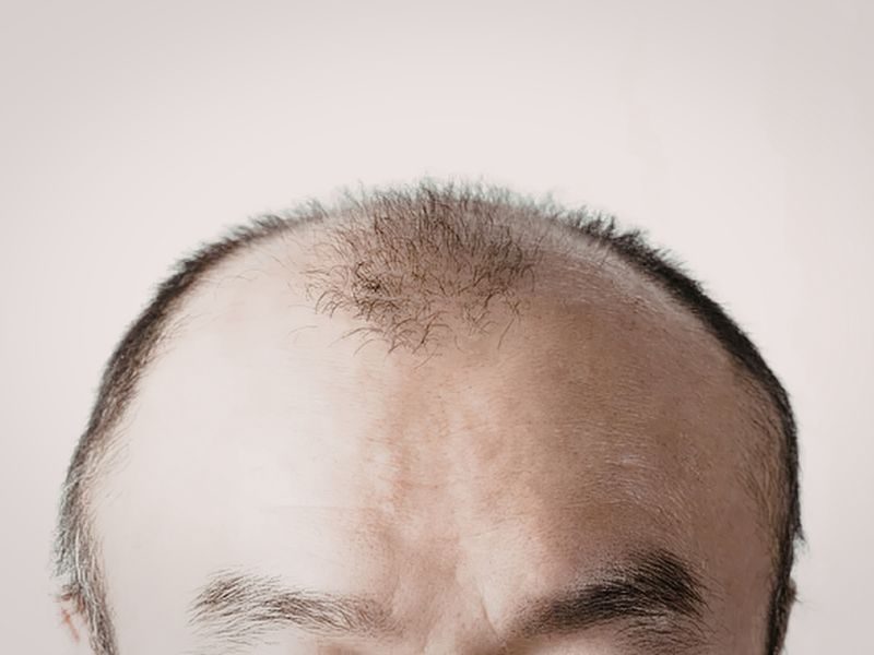 Tratamiento para la alopecia androgenética