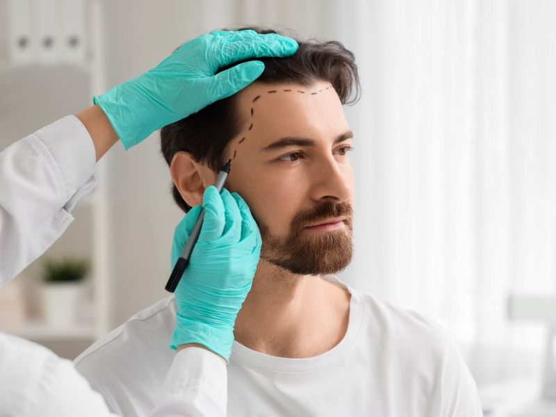 Trasplante capilar masculino