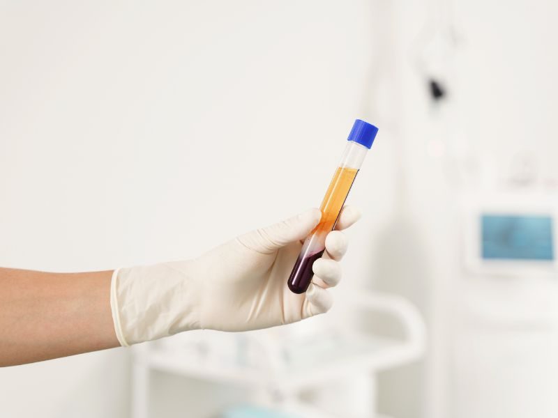 Tratamiento con PRP (plasma rico en plaquetas)