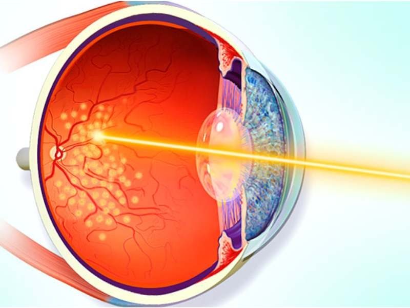 Fotocoagulação com Laser de Argônio