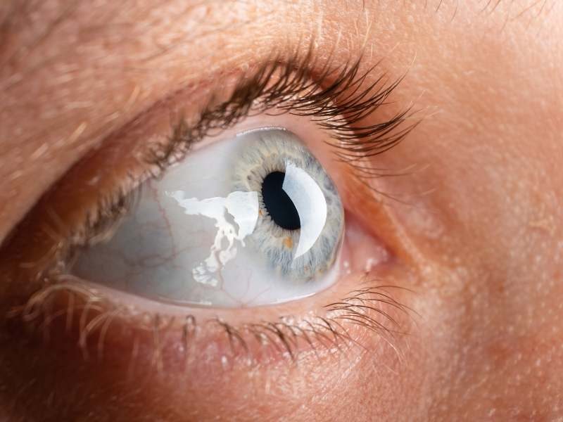 Tratamento para Ceratocone