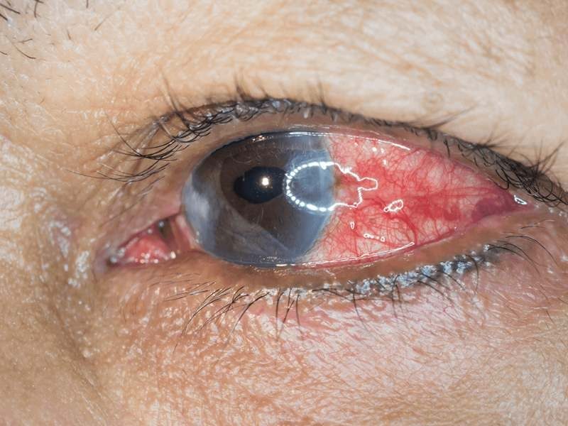 Tratamento para Descolamento da Retina
