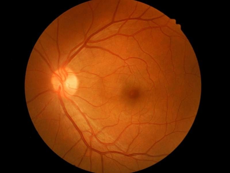 Estereofoto de papila: Retinografia